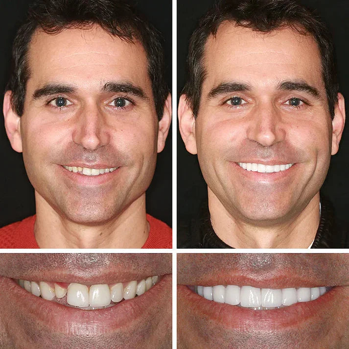 🏆Ends Today: 70% OFF!  🏆2026 Best selling Product🦷 Fit for a Fresh Smile, Say Goodbye to Wearing Discomfort!🌎