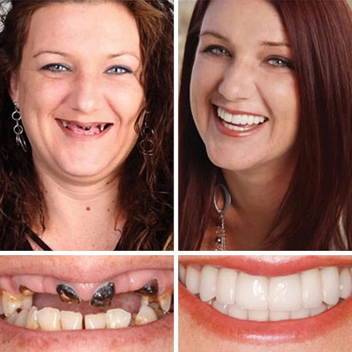 🏆2026 Bestselling Product🦷 Fit for a Fresh Smile, Say Goodbye to Wearing Discomfort!🌎