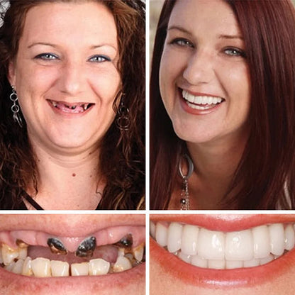🏆2026 Bestselling Product🦷 Fit for a Fresh Smile, Say Goodbye to Wearing Discomfort!🌎