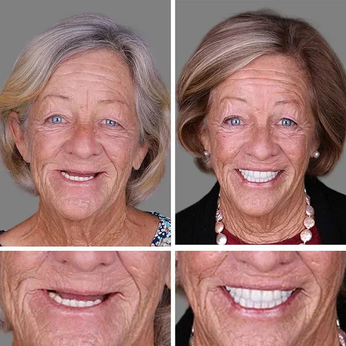 🏆Ends Today: 70% OFF!  🏆2026 Best selling Product🦷 Fit for a Fresh Smile, Say Goodbye to Wearing Discomfort!🌎