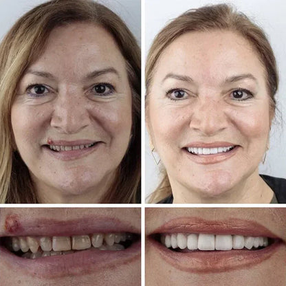 🏆Ends Today: 70% OFF!  🏆2026 Best selling Product🦷 Fit for a Fresh Smile, Say Goodbye to Wearing Discomfort!🌎