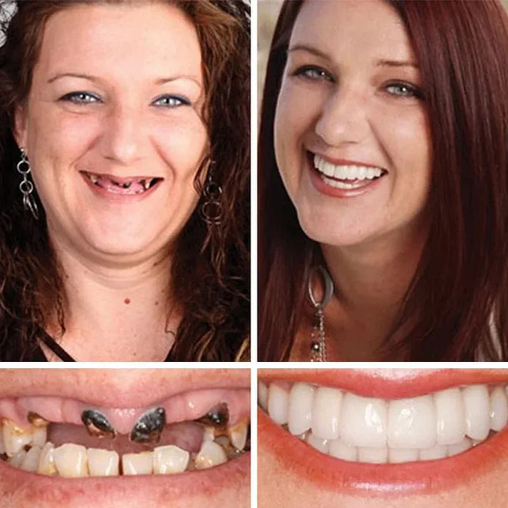 🏆Ends Today: 70% OFF!  🏆2026 Best selling Product🦷 Fit for a Fresh Smile, Say Goodbye to Wearing Discomfort!🌎